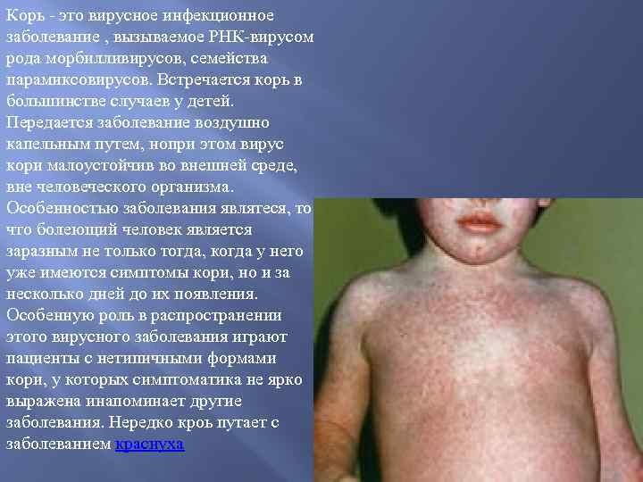Корь - это вирусное инфекционное заболевание , вызываемое РНК-вирусом рода морбилливирусов, семейства парамиксовирусов. Встречается