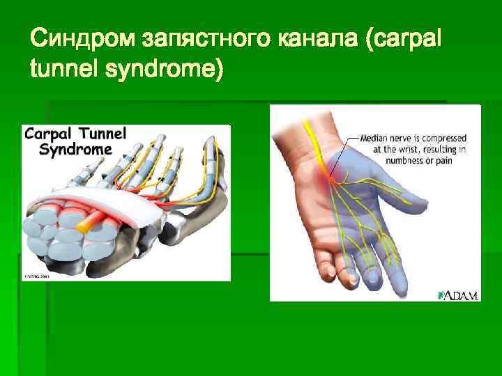 Синдром запястного канала (carpal tunnel syndrome) 