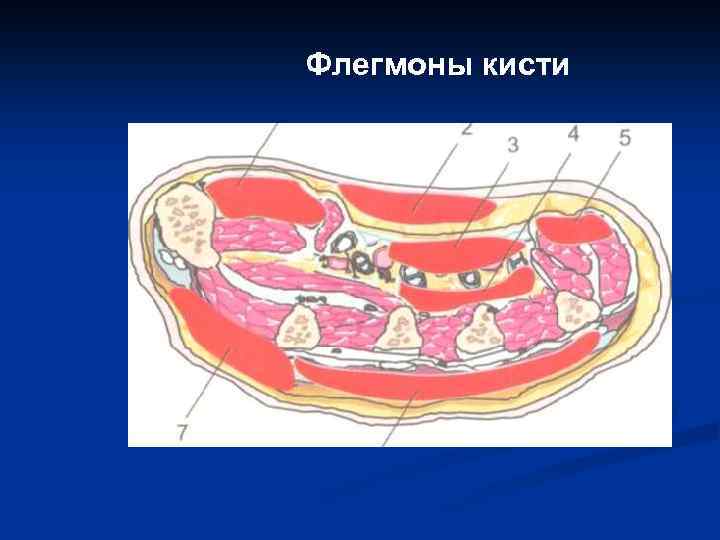 Флегмоны кисти 