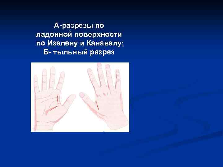 А-разрезы по ладонной поверхности по Изелену и Канавелу; Б- тыльный разрез 