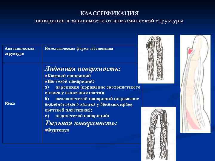 Классификация панарициев. Подкожный панариций классификация. Классификация панарициев топографическая анатомия. Классификация панарициев хирургия. Анатомическая классификация панарициев.