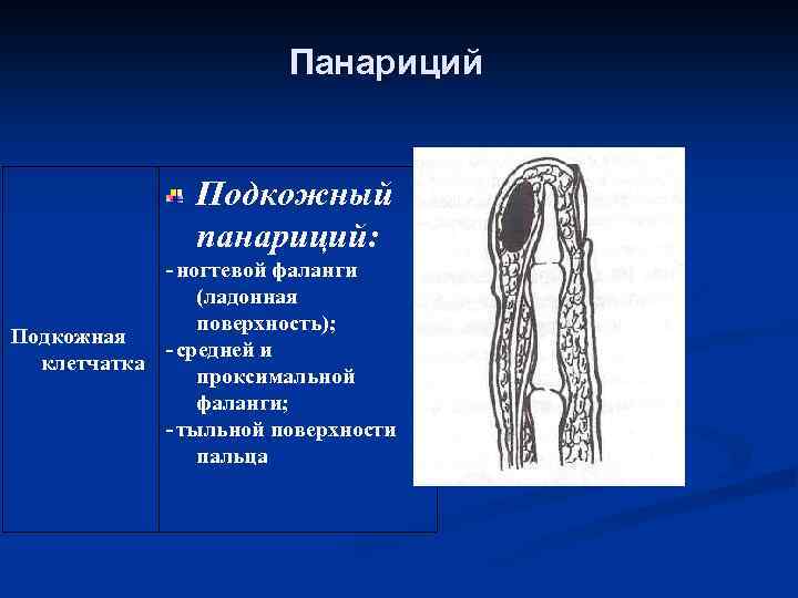 Панариций Подкожный панариций: -ногтевой фаланги (ладонная поверхность); Подкожная -средней и клетчатка проксимальной фаланги; -тыльной