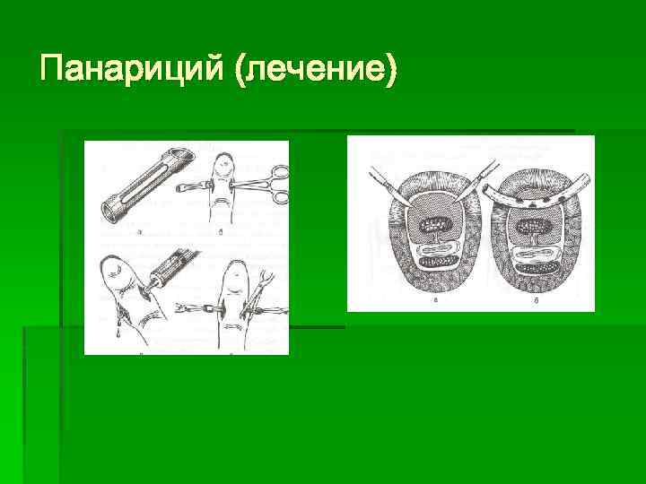 Панариций (лечение) 