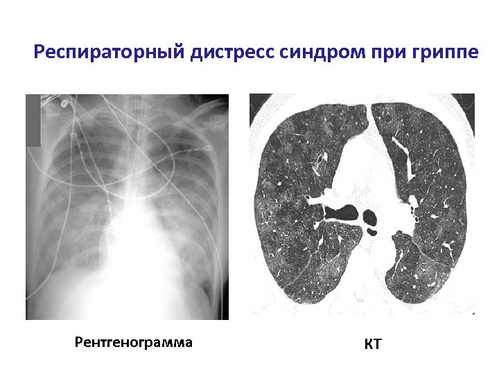 Респираторный дистресс синдром при гриппе Рентгенограмма КТ 