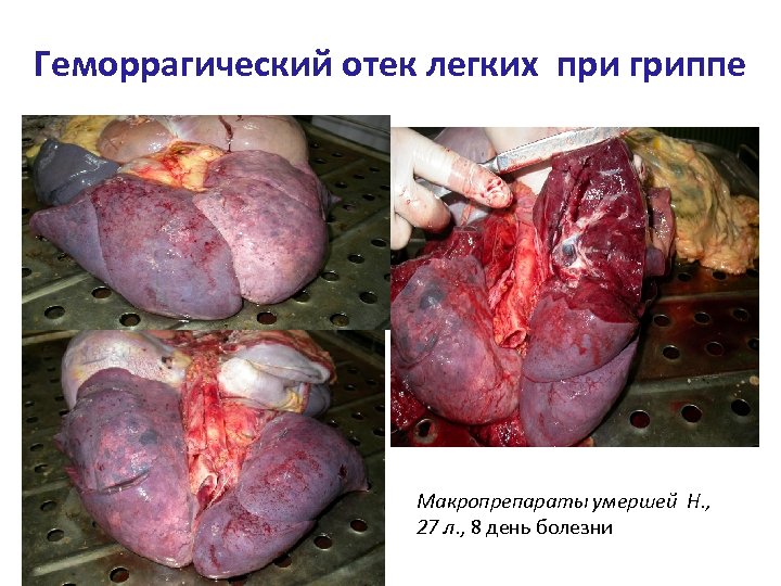 Геморрагический отек легких при гриппе Макропрепараты умершей Н. , 27 л. , 8 день