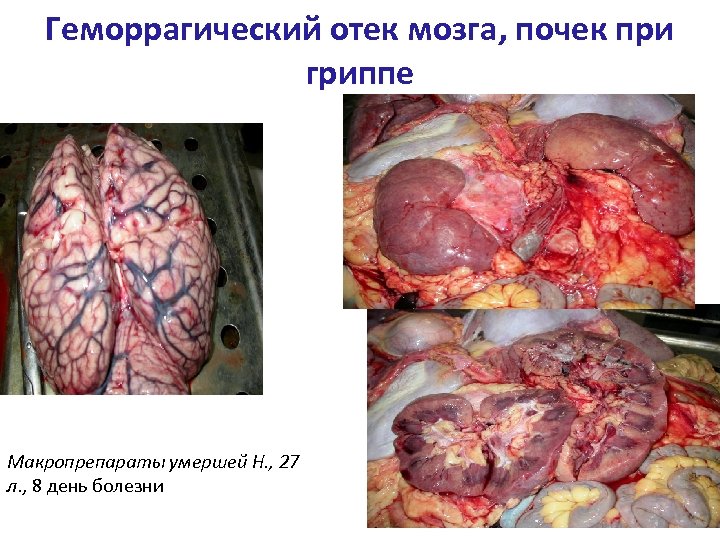 Геморрагический отек мозга, почек при гриппе Макропрепараты умершей Н. , 27 л. , 8