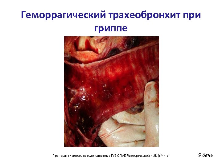 Геморрагический трахеобронхит при гриппе Препарат главного патологоанатома ГУЗ ОПАБ Чарторижской Н. Н. (г. Чита)