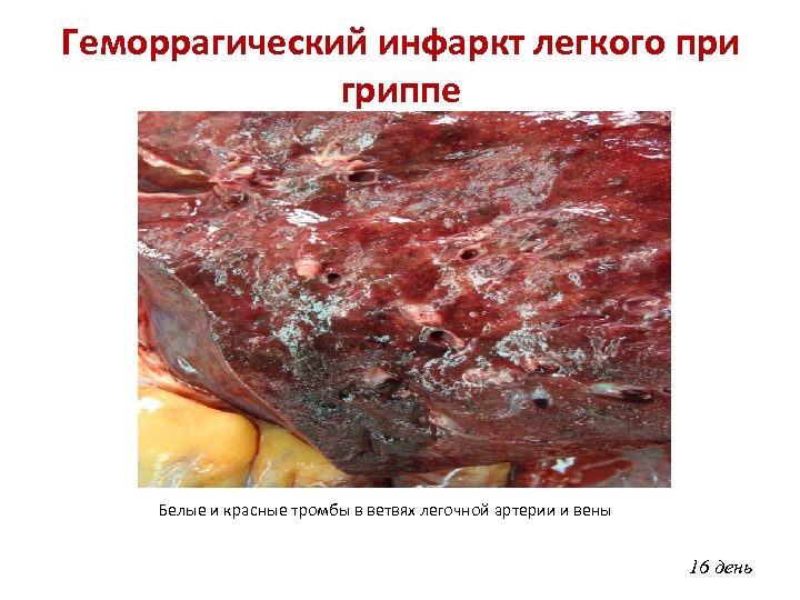 Геморрагический инфаркт легкого при гриппе Белые и красные тромбы в ветвях легочной артерии и