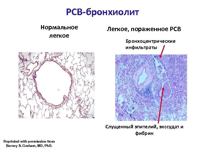 РСВ-бронхиолит Нормальное легкое Легкое, пораженное РСВ Бронхоцентрические инфильтраты Слущенный эпителий, экссудат и фибрин Reprinted