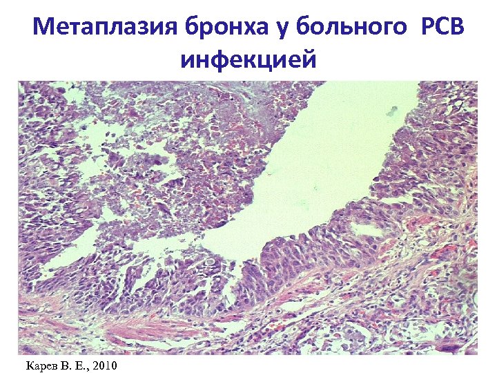 Метаплазия бронха у больного РСВ инфекцией Карев В. Е. , 2010 