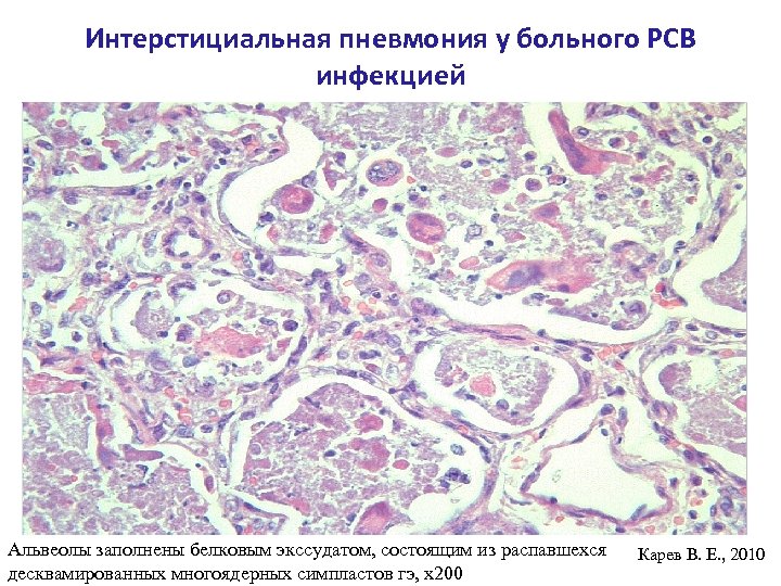 Интерстициальная пневмония у больного РСВ инфекцией Альвеолы заполнены белковым экссудатом, состоящим из распавшехся десквамированных