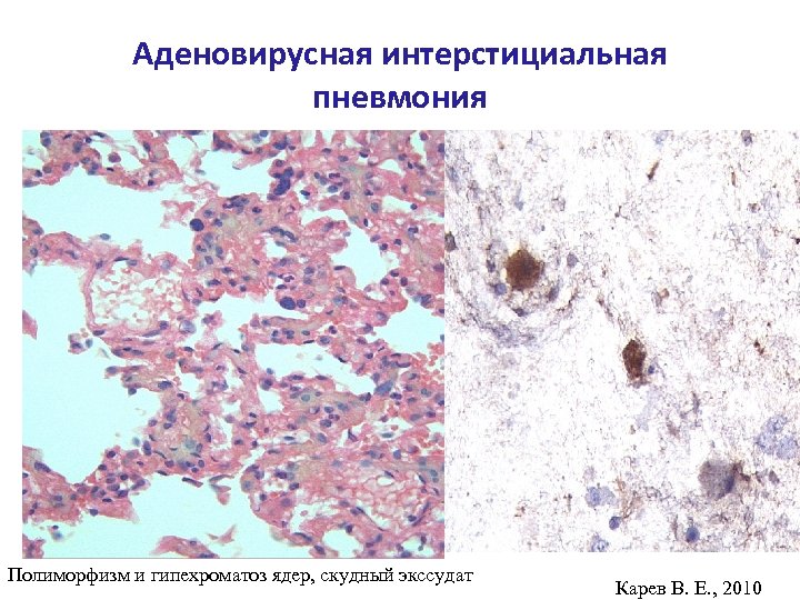 Аденовирусная интерстициальная пневмония Полиморфизм и гипехроматоз ядер, скудный экссудат Карев В. Е. , 2010