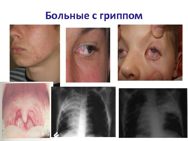 Больные с гриппом 