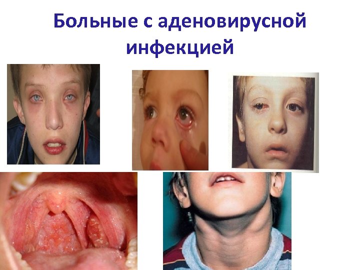 Больные с аденовирусной инфекцией 