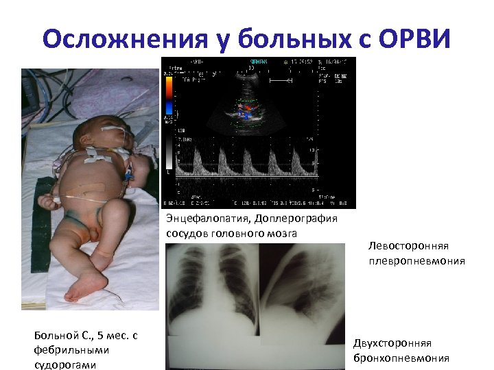 Осложнения у больных с ОРВИ Энцефалопатия, Доплерография сосудов головного мозга Больной С. , 5