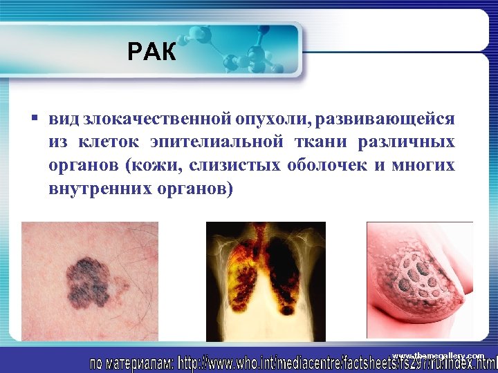 РАК § вид злокачественной опухоли, развивающейся из клеток эпителиальной ткани различных органов (кожи, слизистых