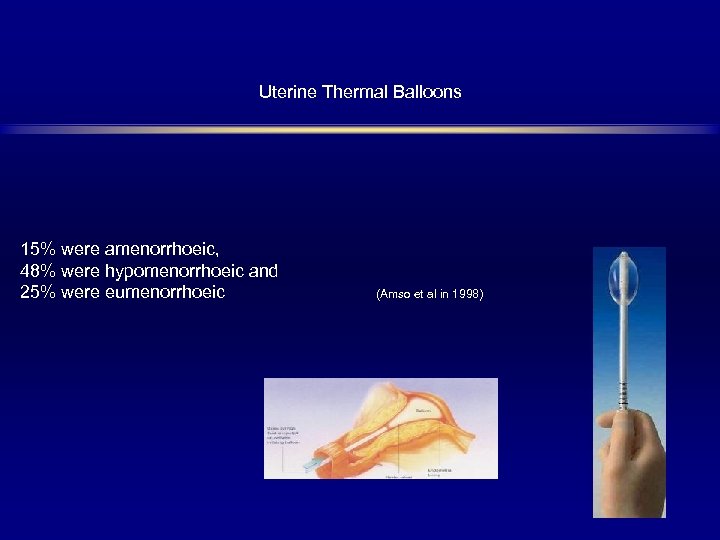 Uterine Thermal Balloons 15% were amenorrhoeic, 48% were hypomenorrhoeic and 25% were eumenorrhoeic (Amso