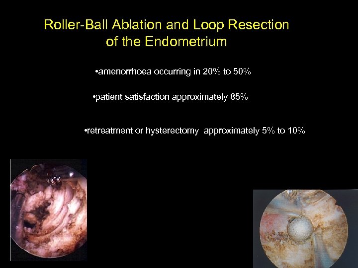 Roller-Ball Ablation and Loop Resection of the Endometrium • amenorrhoea occurring in 20% to