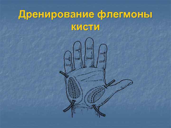 Дренирование флегмоны кисти 