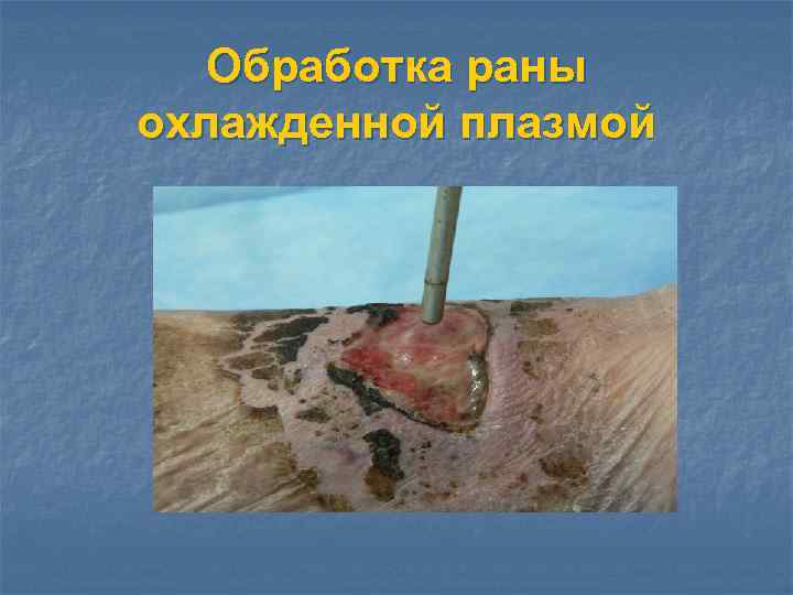 Обработка раны охлажденной плазмой 