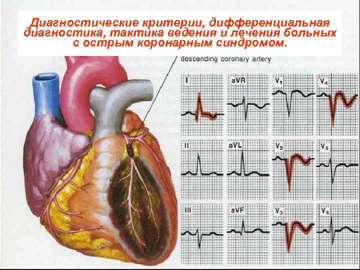 Диагностические критерии, дифференциальная диагностика, тактика ведения и лечения больных с острым коронарным синдромом. 
