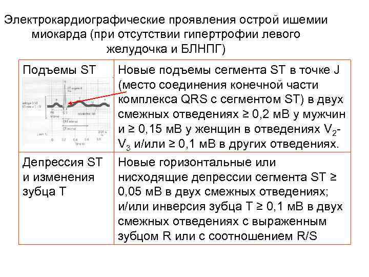 Электрокардиографические проявления острой ишемии миокарда (при отсутствии гипертрофии левого желудочка и БЛНПГ) Подъемы ST