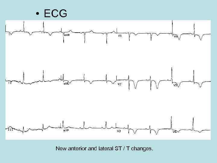  • ECG New anterior and lateral ST / T changes. 