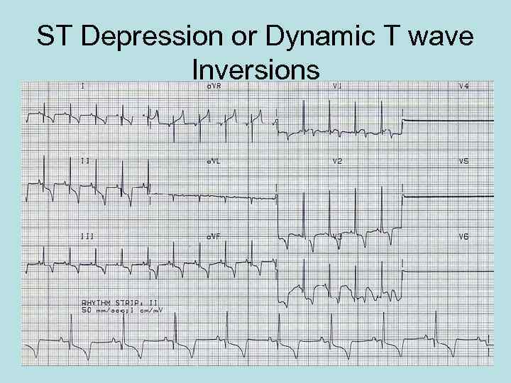 ST Depression or Dynamic T wave Inversions 