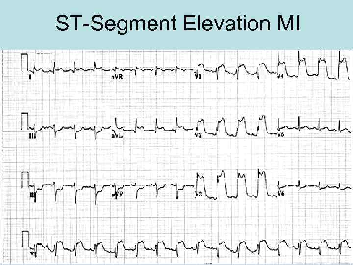 ST-Segment Elevation MI 
