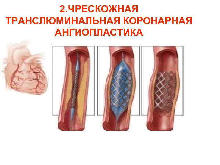 Транслюминальная баллонная ангиопластика