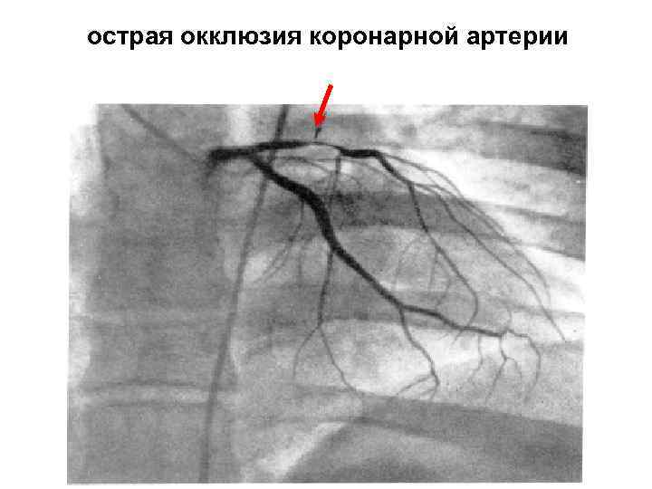 острая окклюзия коронарной артерии 
