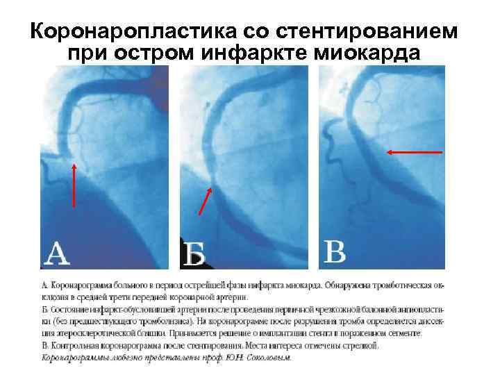 Коронаропластика со стентированием при остром инфаркте миокарда 