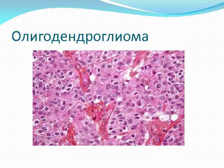 Олигодендроглиома 