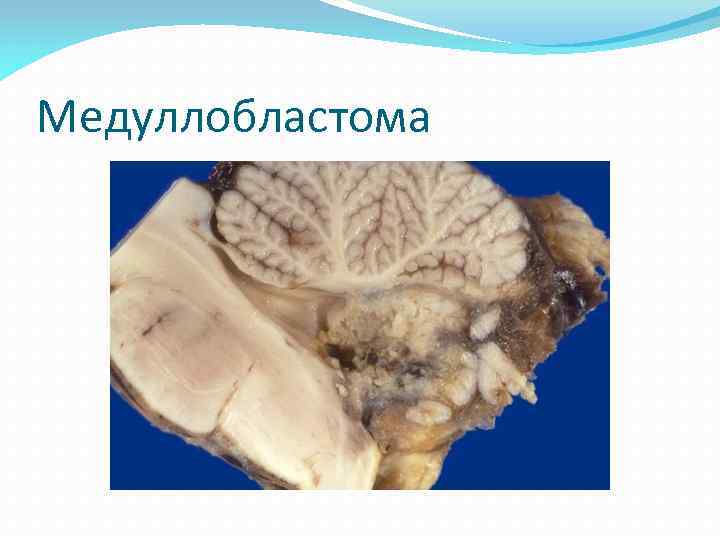 Медуллобластома 