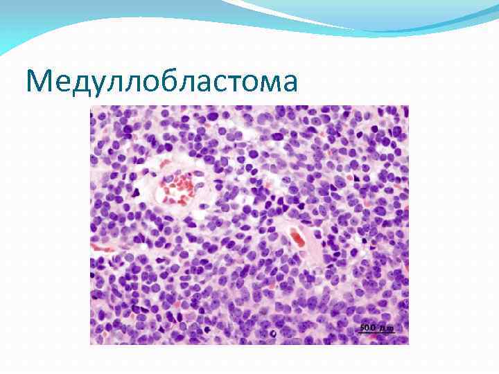 Медуллобластома 