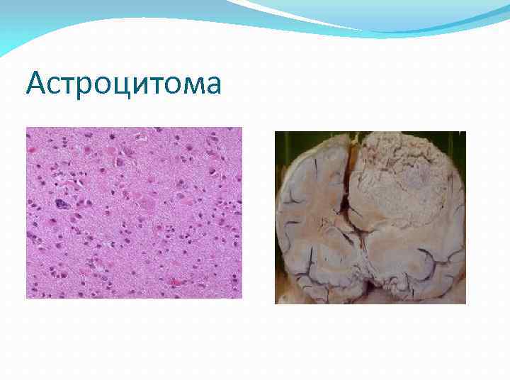 Астроцитома 