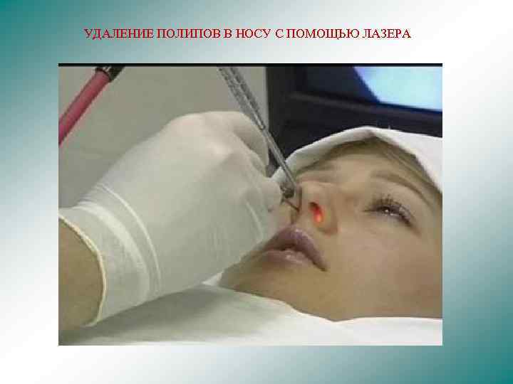 УДАЛЕНИЕ ПОЛИПОВ В НОСУ С ПОМОЩЬЮ ЛАЗЕРА 