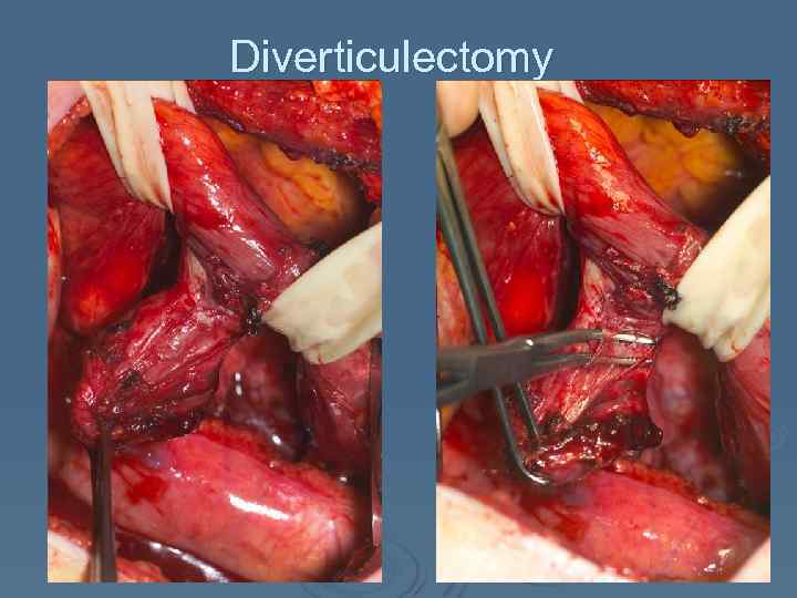 Diverticulectomy 