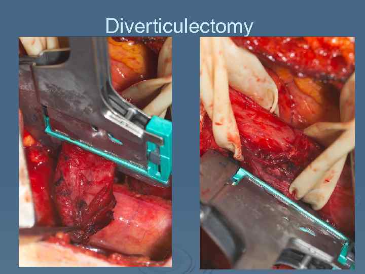Diverticulectomy 