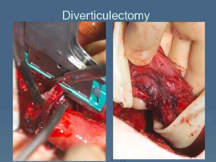 Diverticulectomy 