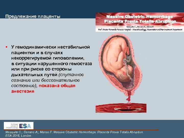 Предлежание плаценты § У гемодинамически нестабильной пациентки и в случаях некоррегируемой гиповолемии, в ситуации