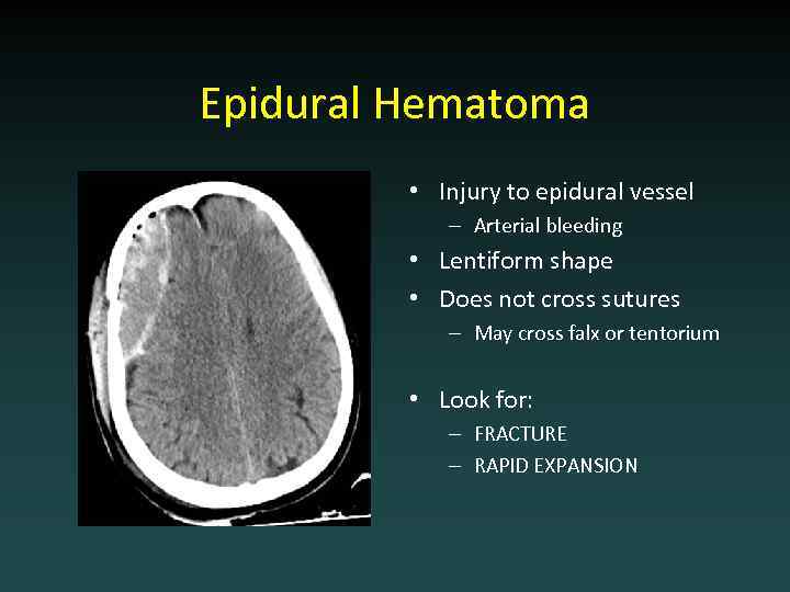 Epidural Hematoma • Injury to epidural vessel – Arterial bleeding • Lentiform shape •