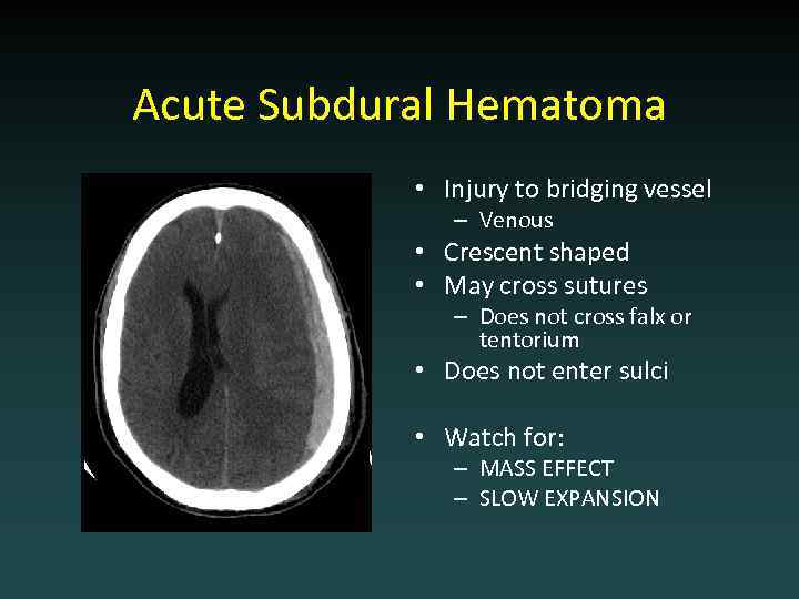 Acute Subdural Hematoma • Injury to bridging vessel – Venous • Crescent shaped •