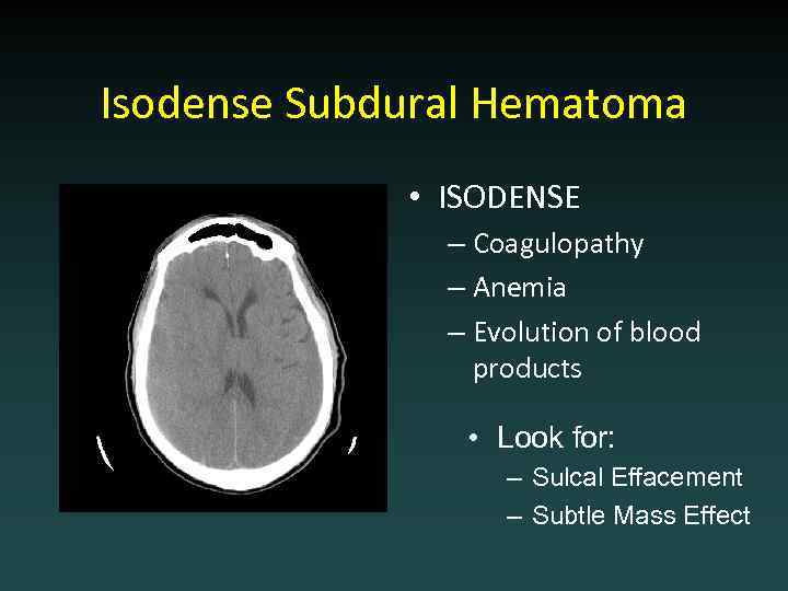 Isodense Subdural Hematoma • ISODENSE – Coagulopathy – Anemia – Evolution of blood products