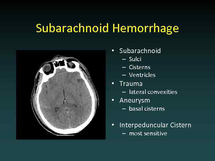Subarachnoid Hemorrhage • Subarachnoid – Sulci – Cisterns – Ventricles • Trauma – lateral
