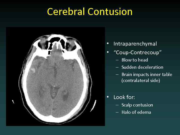 Cerebral Contusion • Intraparenchymal • “Coup-Contrecoup” – Blow to head – Sudden deceleration –