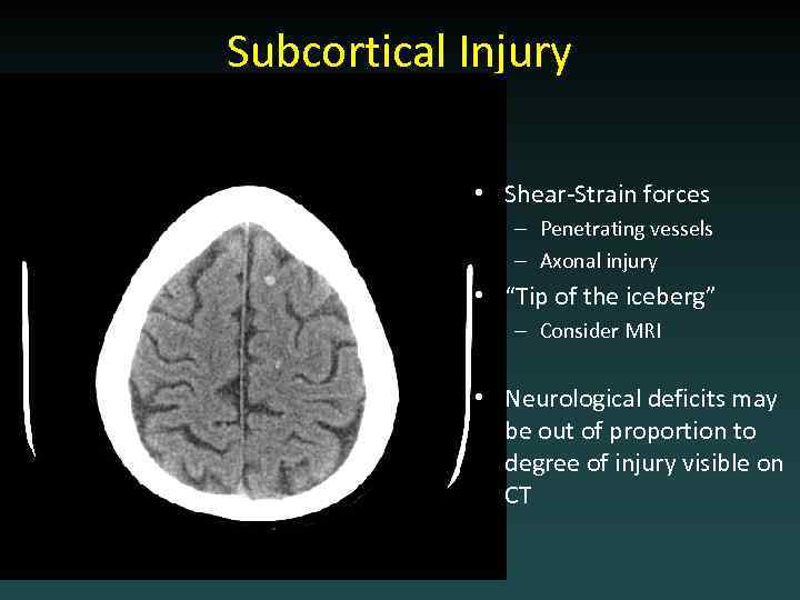 Subcortical Injury • Shear-Strain forces – Penetrating vessels – Axonal injury • “Tip of