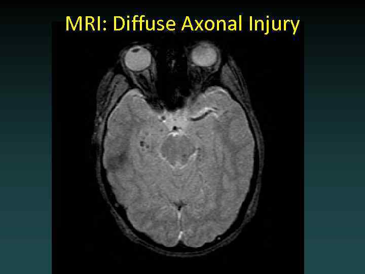 MRI: Diffuse Axonal Injury 