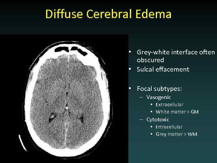 Diffuse Cerebral Edema • Grey-white interface often obscured • Sulcal effacement • Focal subtypes: