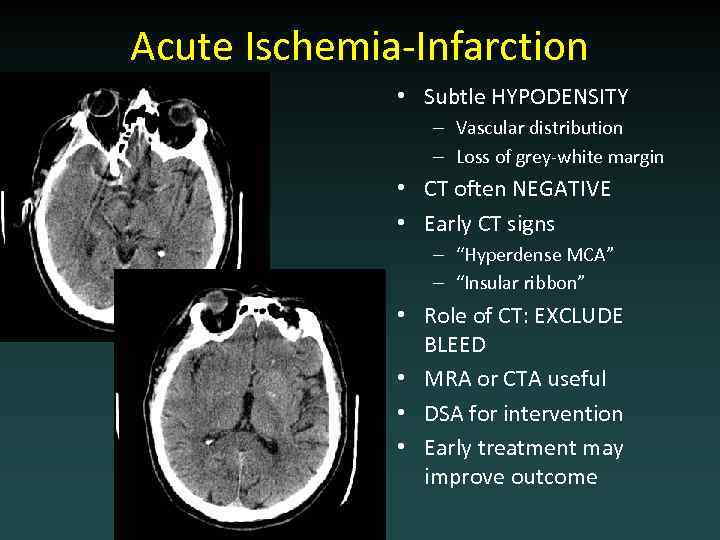 Acute Ischemia-Infarction • Subtle HYPODENSITY – Vascular distribution – Loss of grey-white margin •